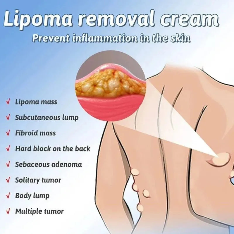 Lipoma Removal Cream | Herbal Skin Care Cream for Smooth & Nourished Skin | Fast-Absorbing Formula | For Neck & Body | 50g