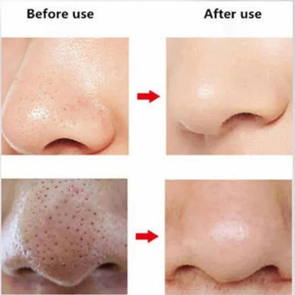 Rechargeable Blackhead Remover Vacuum Cleaner | Model FPLS-001 | Deep Pore Cleansing & Microdermabrasion Device